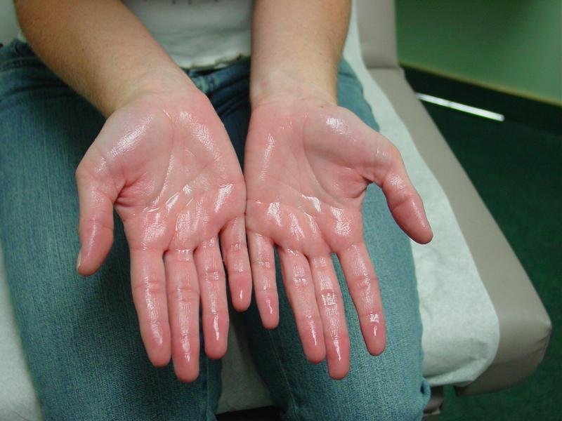 Hyperhidrosis , or excessive sweating diagnosis. The treatment of excessive sweating for adult like sweating hands and feet's includes local , surgical treatment etc.