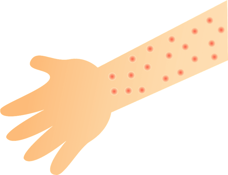 Complication with eczema. There are many complications in dermatitis problem